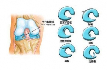 半月板撕裂怎么治疗