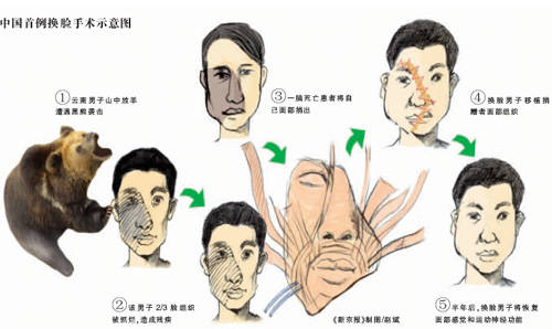 换脸手术真的存在吗