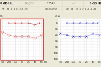 如何鉴定听力损失