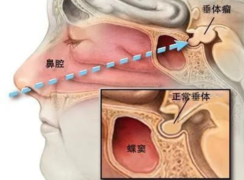 垂体瘤都有哪些症状