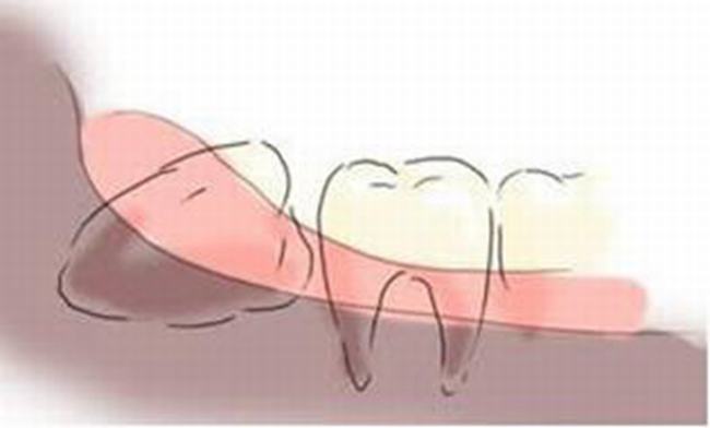 拔智齿后悔死了?这几种情况拔智齿会后悔(千万注意)