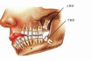 智齿一定要拔吗?哪几种情况必须拔掉
