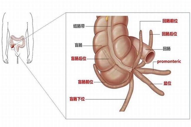 盲肠和阑尾是一回事吗?阑尾是盲肠的末尾(盲肠不能割)