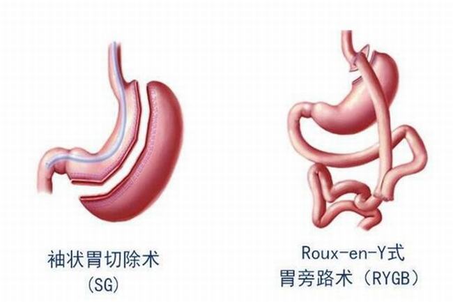 胃切掉了食物怎么消化?一般切除2/3的胃部(吸收靠小肠)