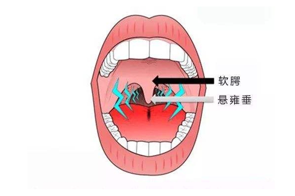 人的小舌有什么用?防止食物和液体倒流鼻腔(食道的小门)