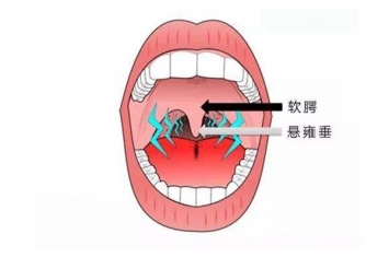 人的小舌有什么用?防止食物和液体倒流鼻腔(食道的小门)