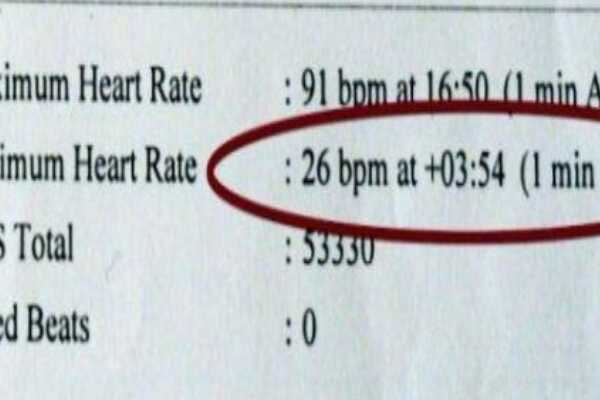 世界上心跳最慢的人:每5秒才跳动一次(每分钟12下)