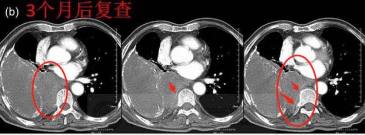 胸腔里打不死的小强可以潜伏20年再发作日本为它走过弯路