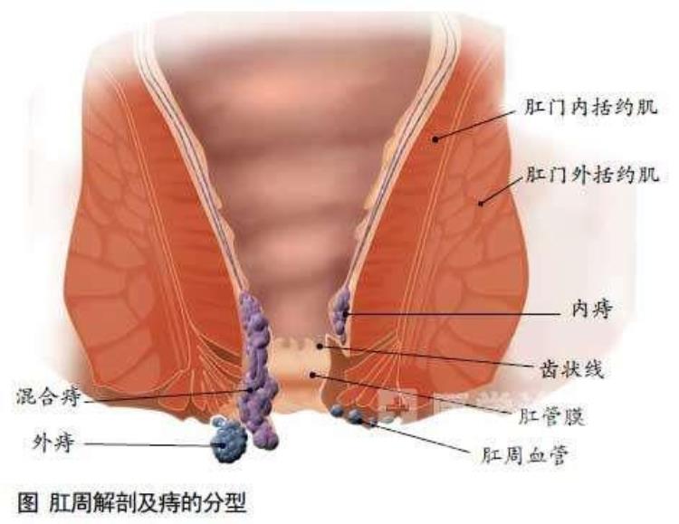 十人九痔是什么意思,十人九痔是什么原因