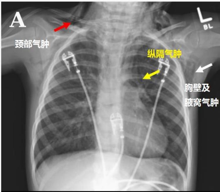 男孩全身多处气肿竟是阿莫西林惹的祸