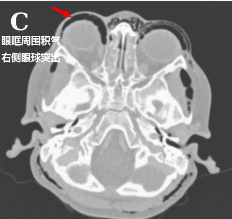 男孩全身多处气肿竟是阿莫西林惹的祸