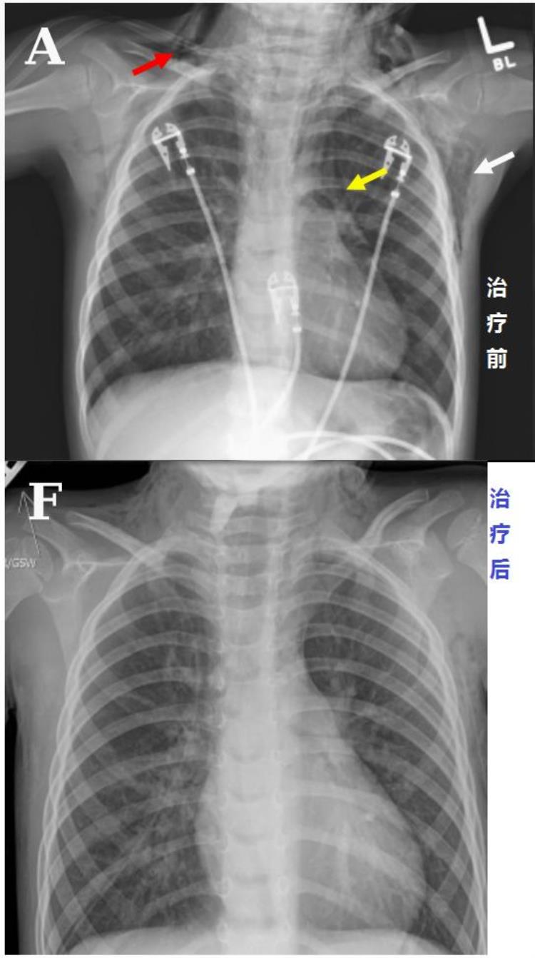 男孩全身多处气肿竟是阿莫西林惹的祸