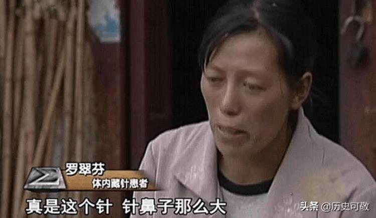 04年云南26岁女子尿血发现体内有26根缝衣针医生1岁前扎的