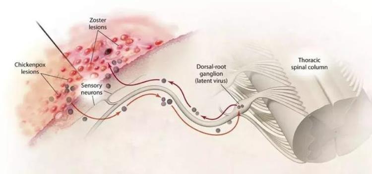 水痘痊愈后病毒会潜伏在神经吗,水痘得一次就终身免疫吗