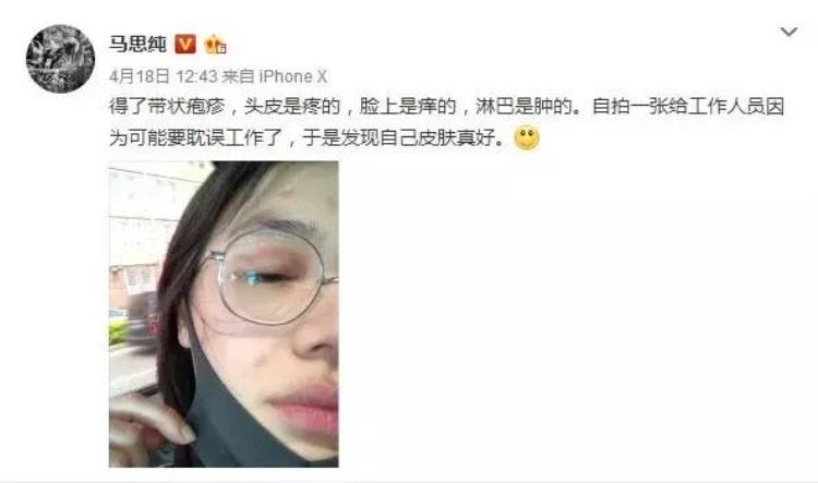 水痘痊愈后病毒会潜伏在神经吗,水痘得一次就终身免疫吗