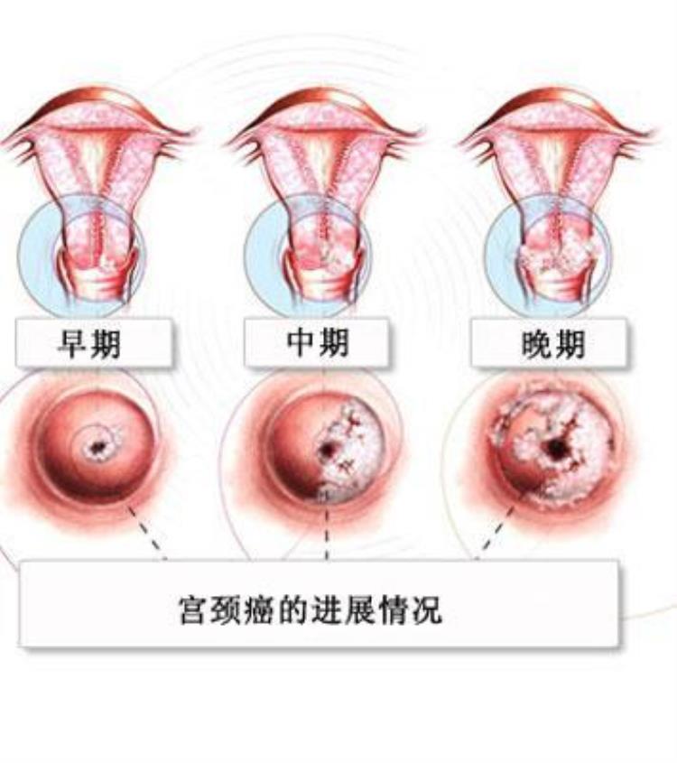 宫颈癌产生原因主要与以下哪个病毒有关,宫颈癌的诱发因素