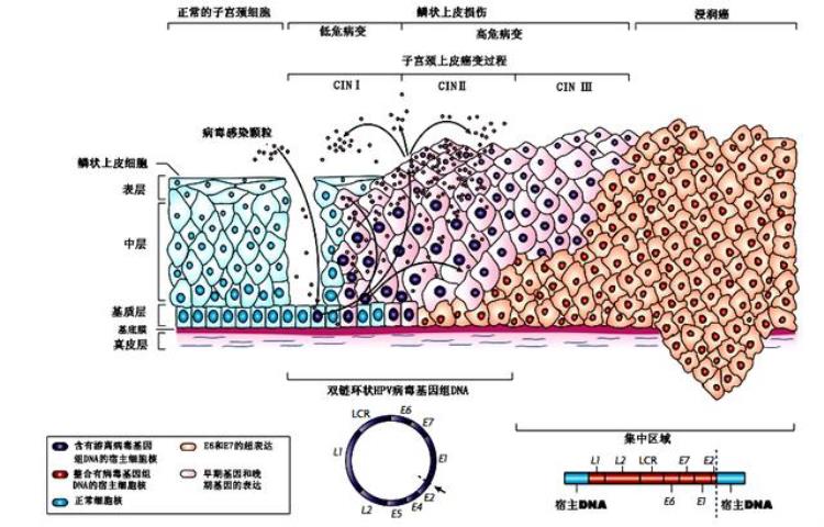 如何理解HPV持续感染,hpv持续阳性怎么办