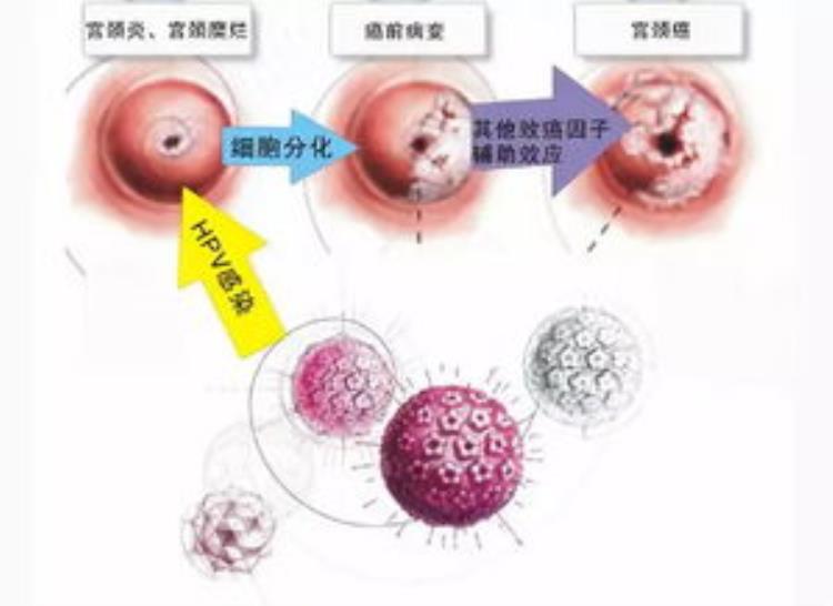 如何理解HPV持续感染,hpv持续阳性怎么办