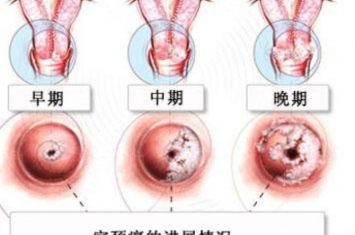 hpv是如何引发癌症的,hpv病毒引起的癌症有哪些