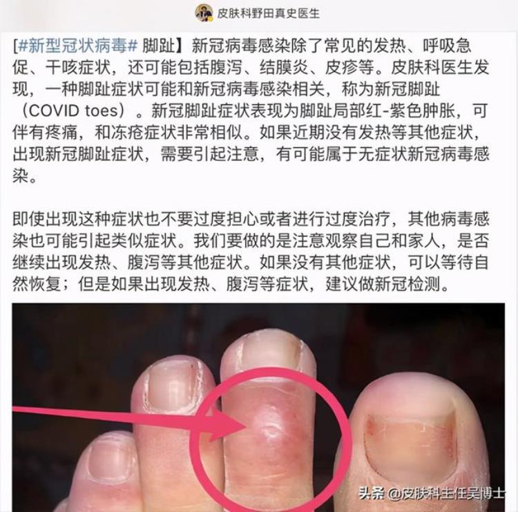 新冠病毒导致皮肤,Covid后遗症