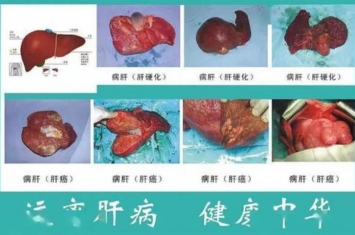 病毒是怎样侵害肝脏的呢,乙肝病毒会侵害肝脏吗