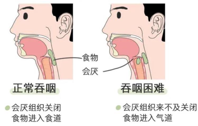 脑梗塞的患者为什么会出现呛咳,脑出血喝水为什么呛咳