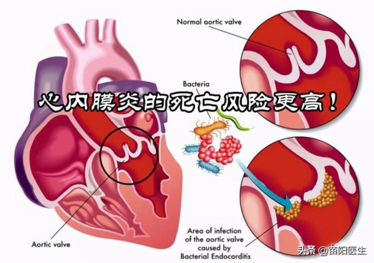 感冒得心脏病,感冒挂点滴的危害