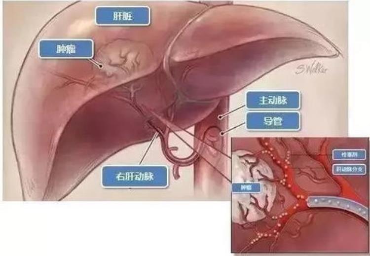 医疗纠纷肝癌介入治疗后腹痛未查原因直接解痉止痛致患者死亡