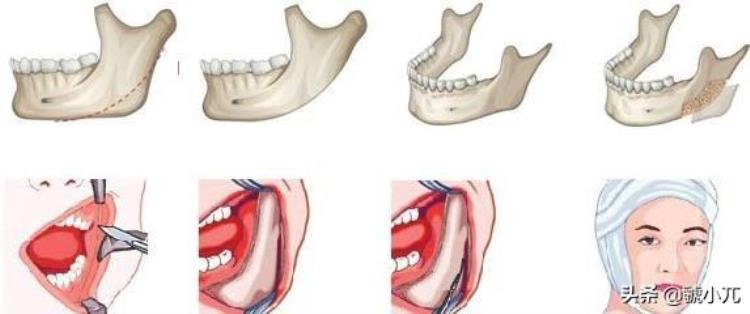 磨骨整容后遗症,整形削骨真实个人经历